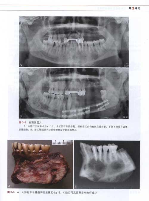 颌骨肿瘤 ppt课件