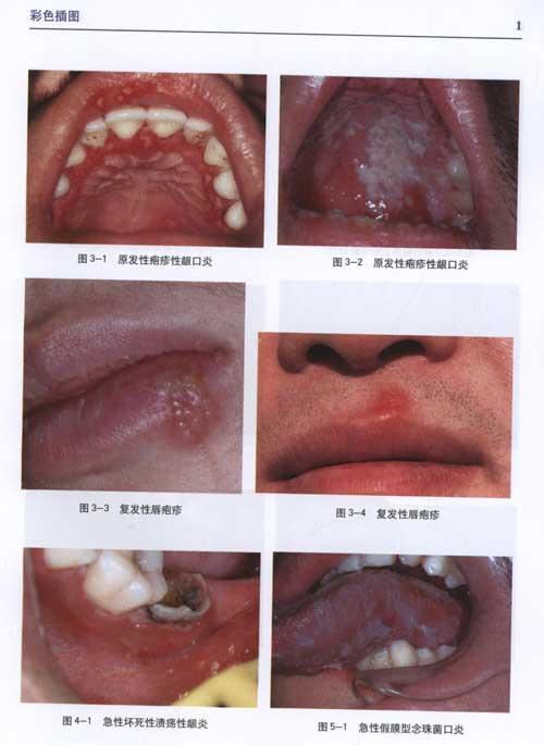 各种口腔疾病图片大全图片